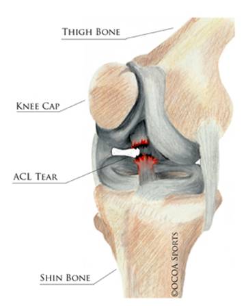 Tennis Medicine: ACL Reconstruction