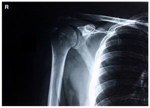 Shoulder_X_Ray_Pic