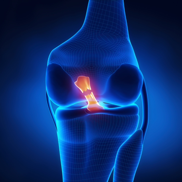 ACL Injuries in Female Athletes